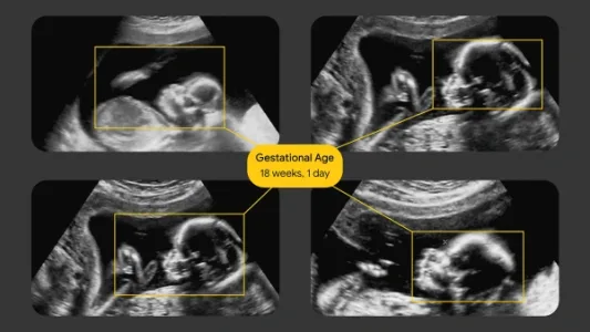 AI 超声检测，孕产妇和婴儿的守护者